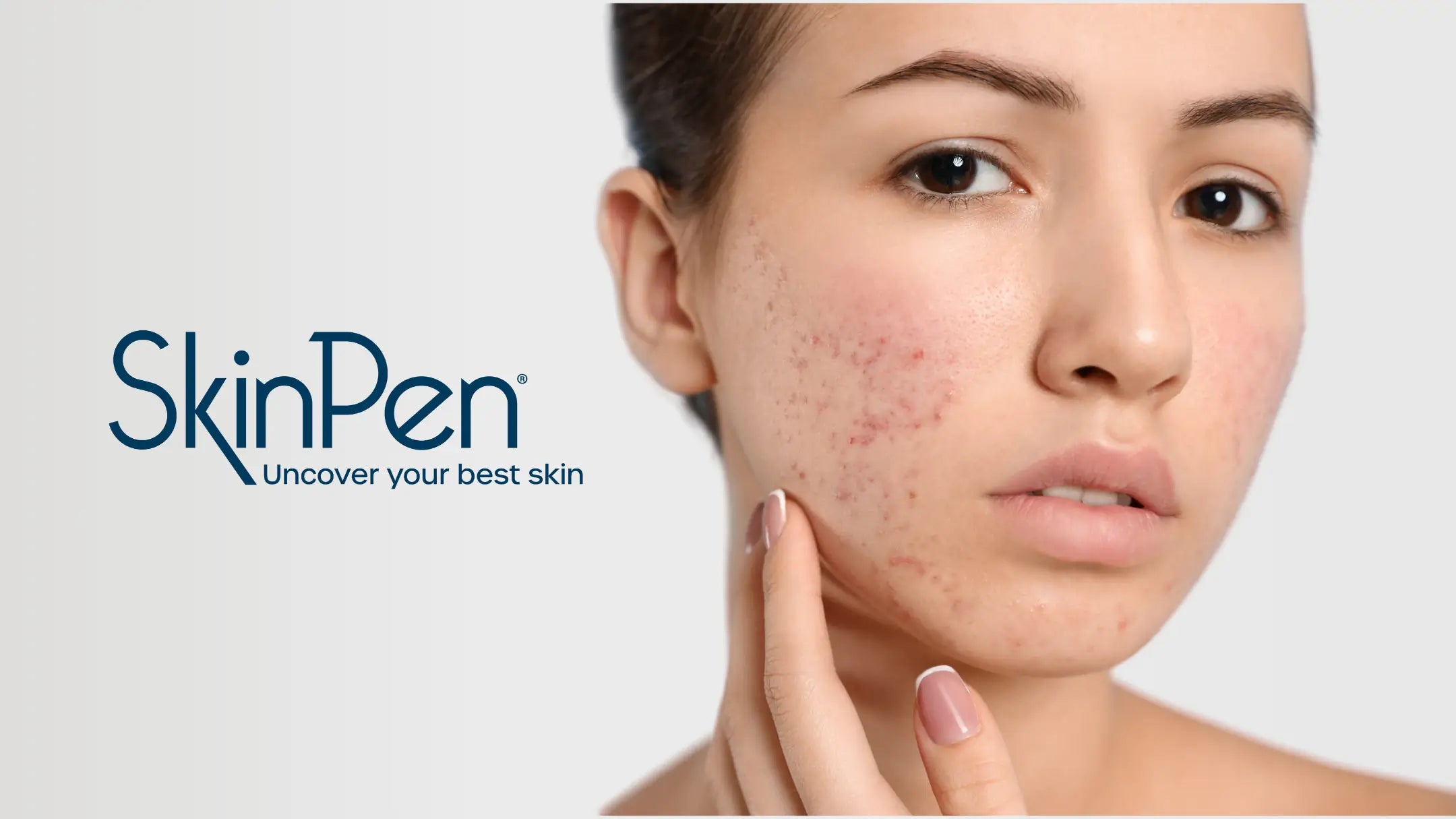 Microneedling for Acne Scars