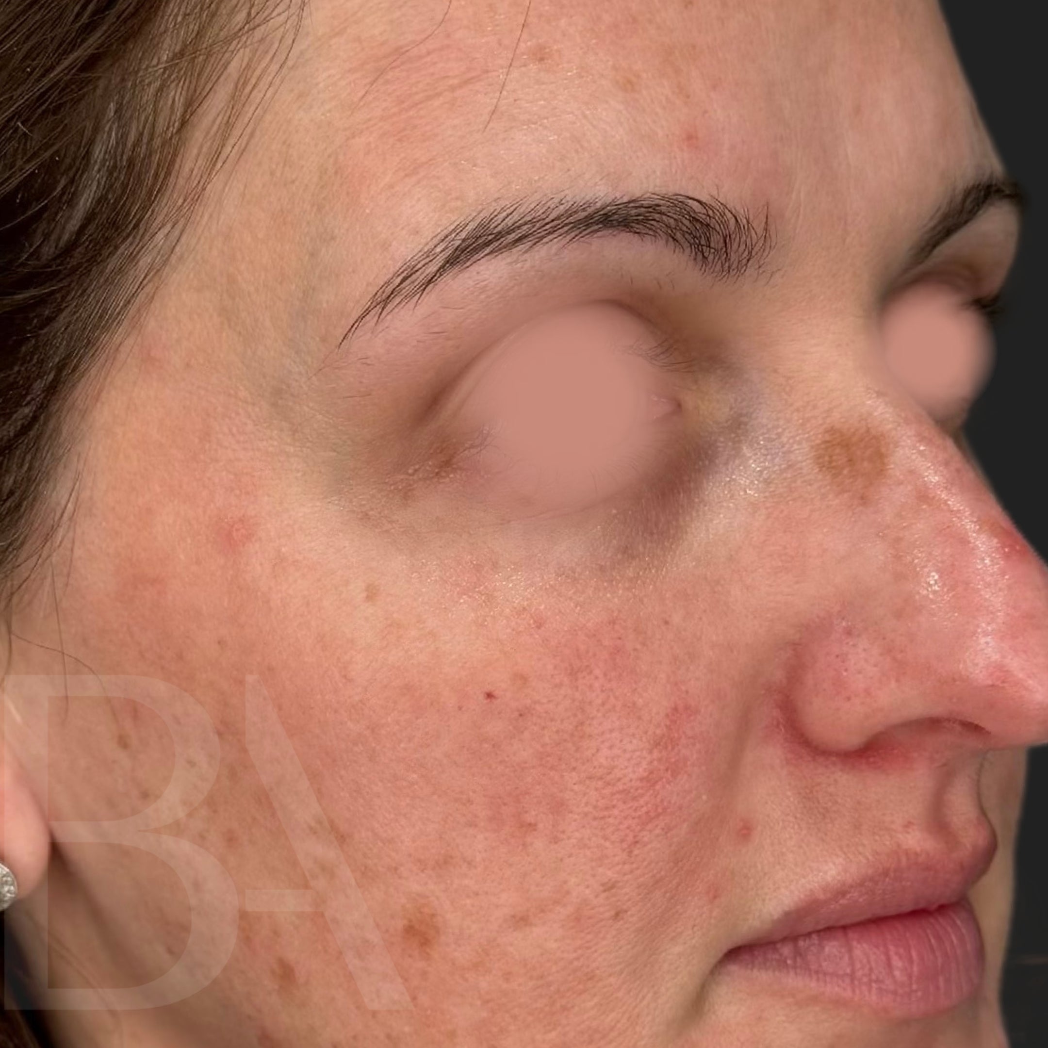 Ultra Before Treatment | Beautiful Aesthetics