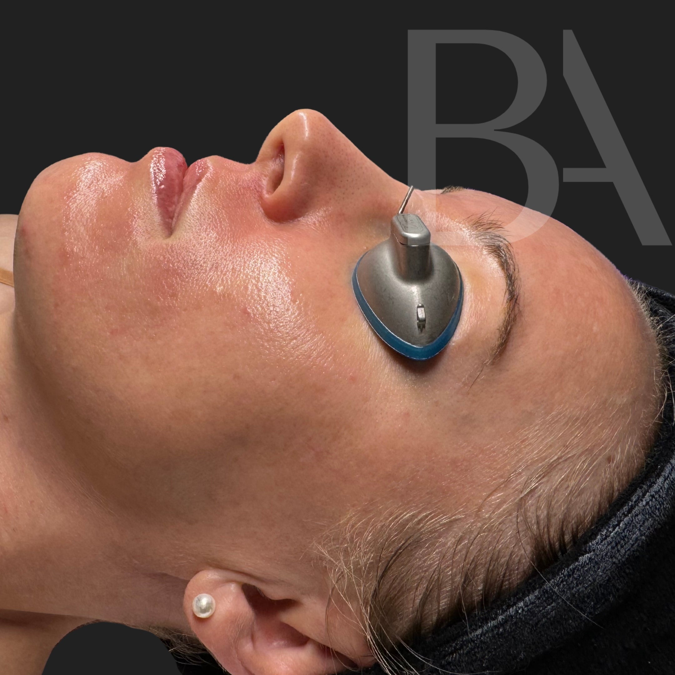 Hydrafacial After Treatment | Beautiful Aesthetics