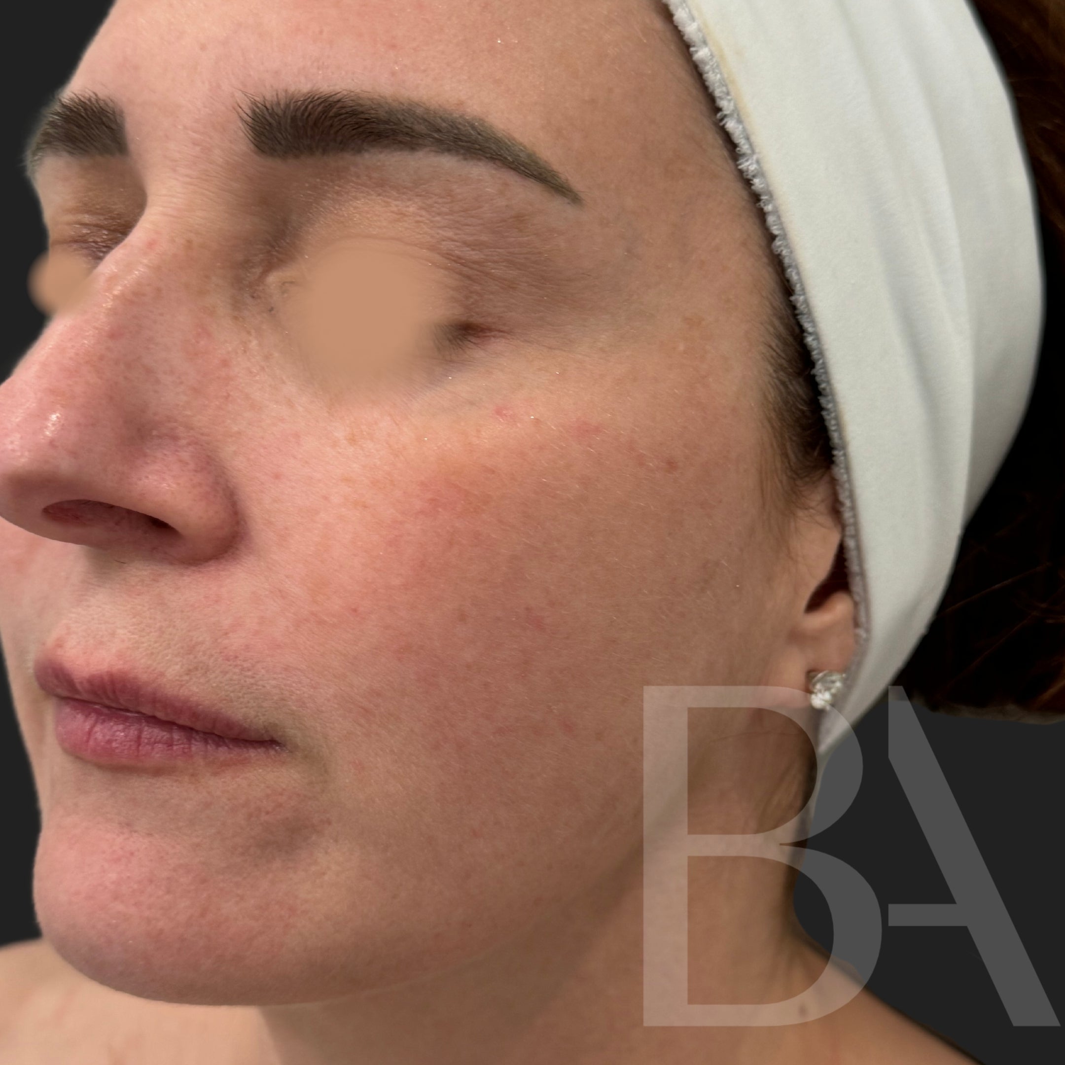 TotalSkin Solution After Treatment | Beautiful Aesthetics