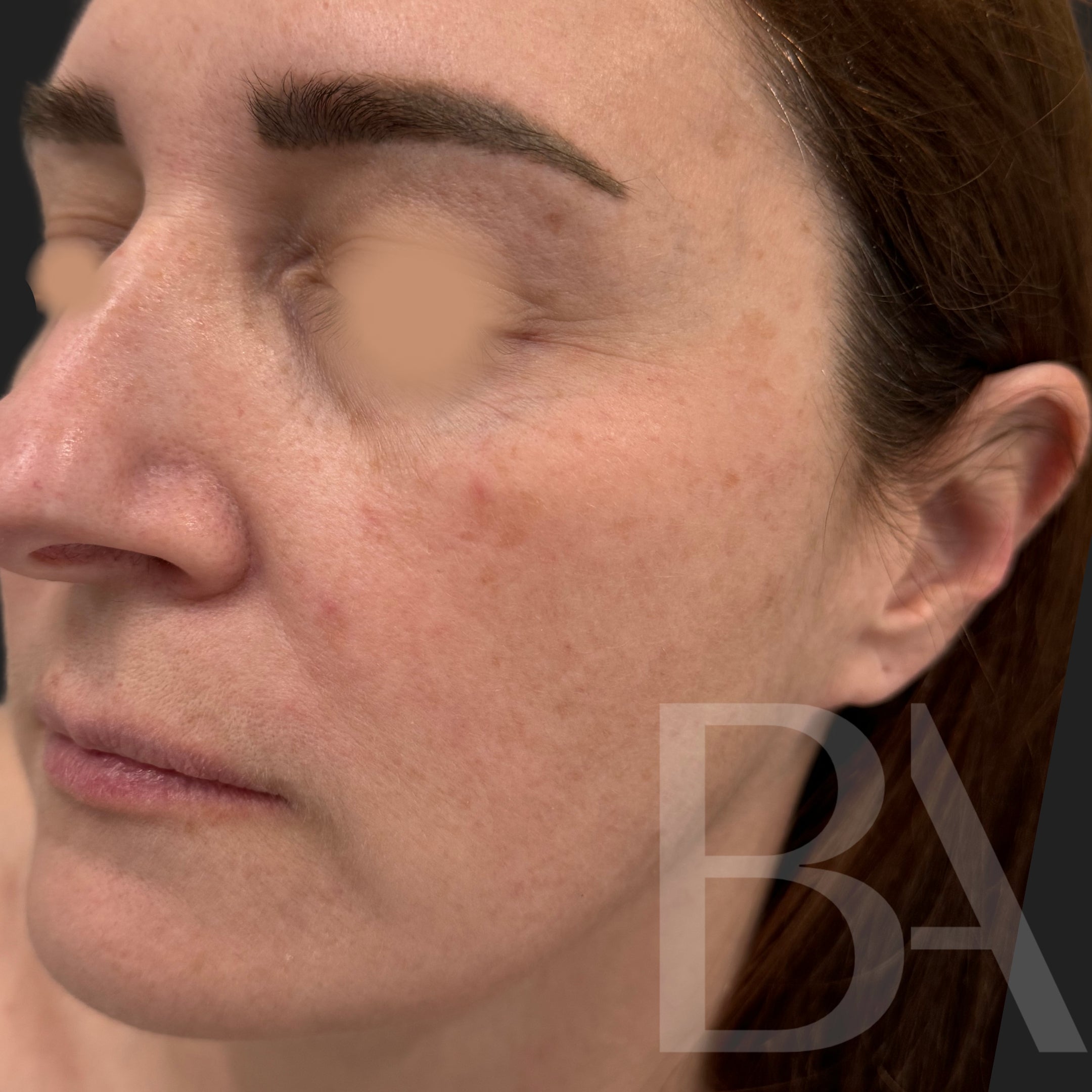 TotalSkin Solution Before Treatment | Beautiful Aesthetics