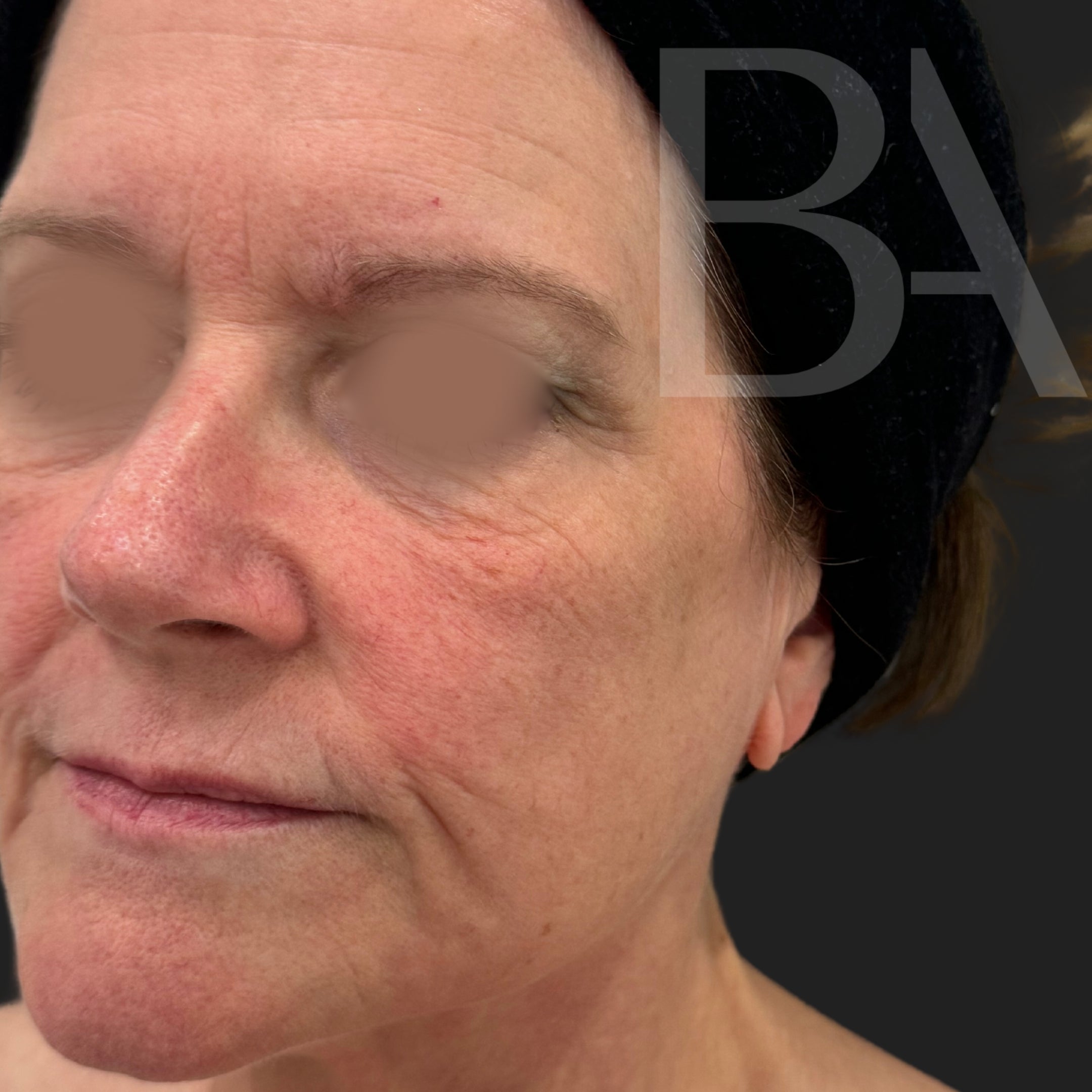 TotalSkin Solution After Treatment | Beautiful Aesthetics