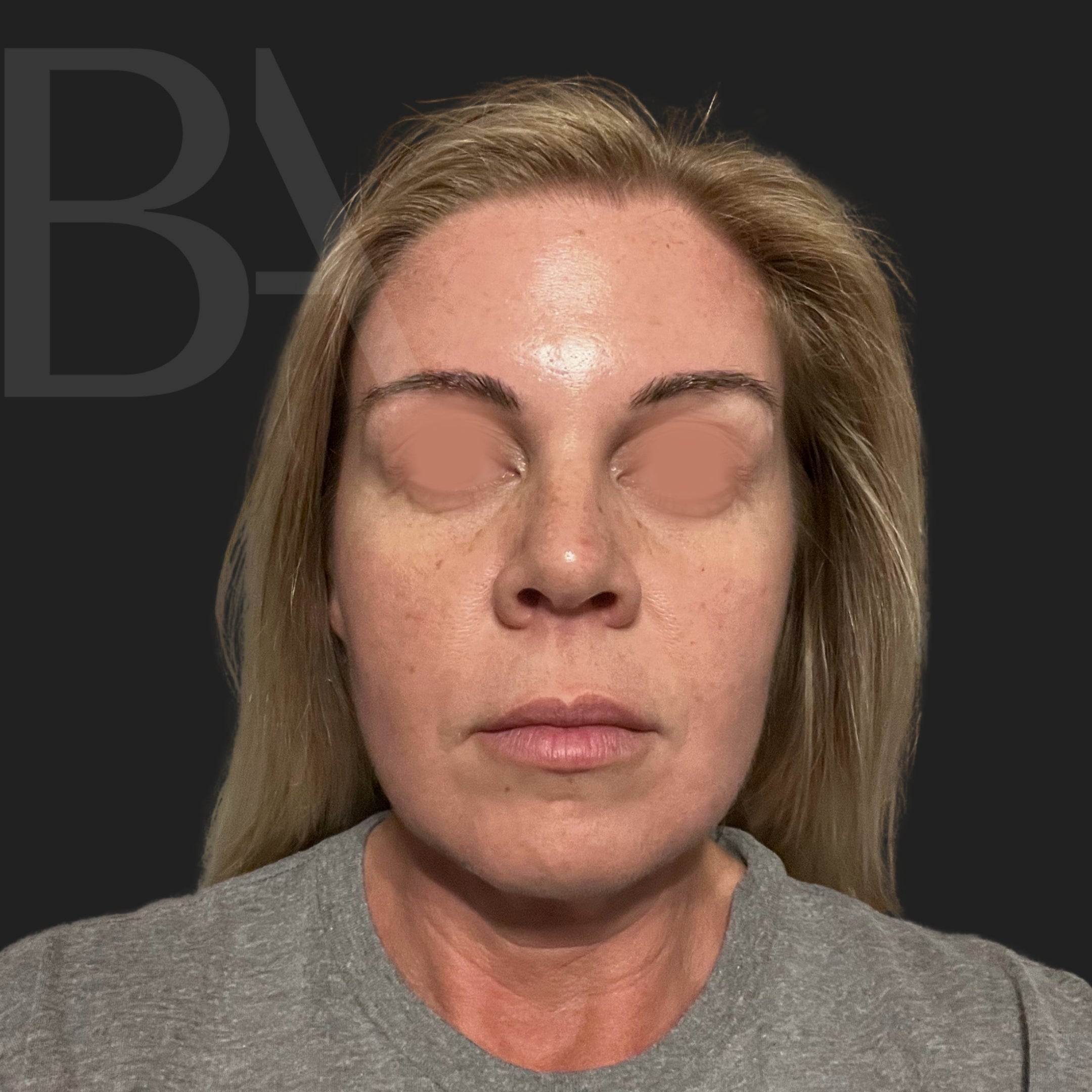 TotalSkin Solution After Treatment | Beautiful Aesthetics