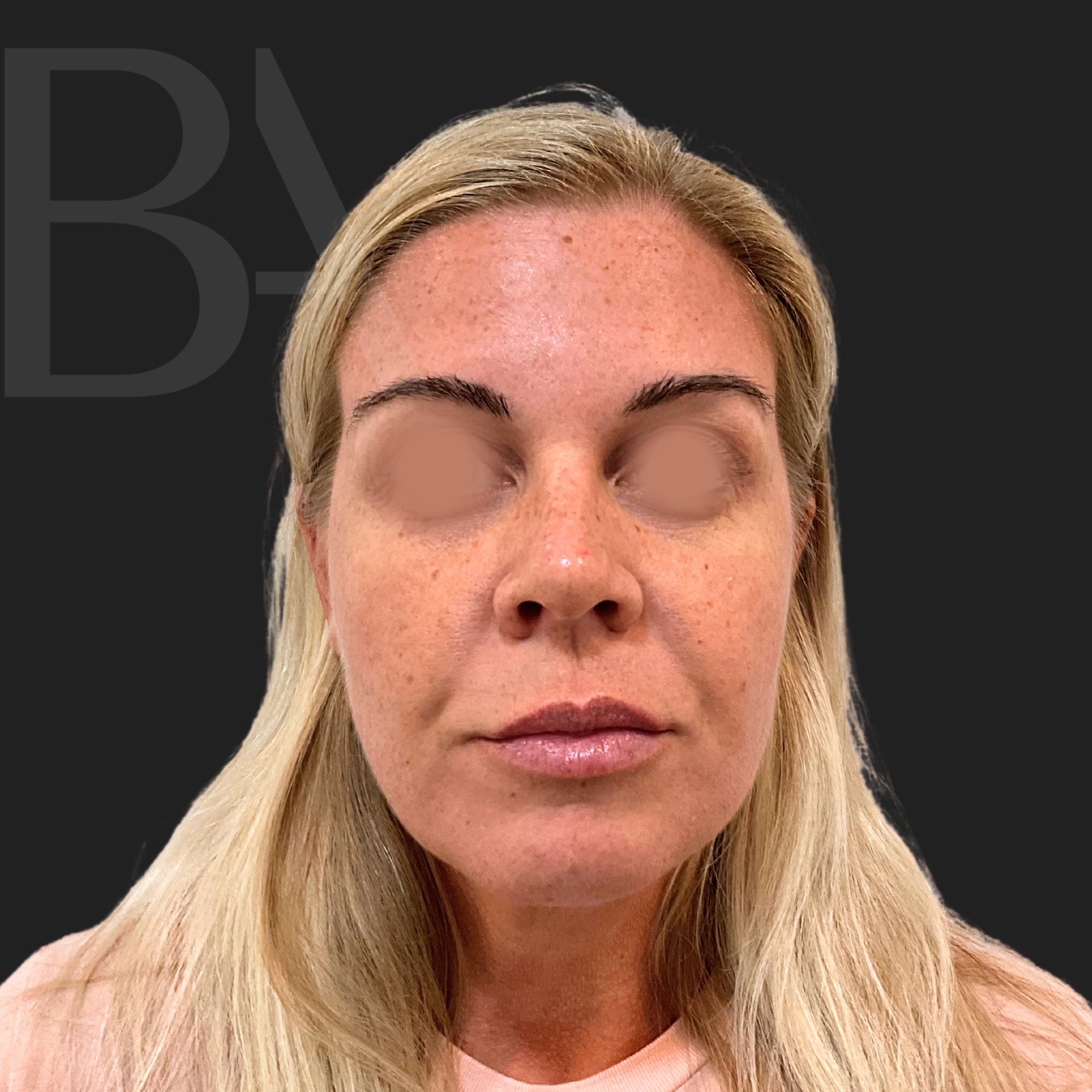 TotalSkin Solution Before Treatment | Beautiful Aesthetics